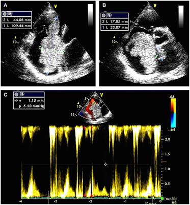 Case Report: Giant Biatrial Myxoma Mimicking Malignant Cardiac Tumor in a Patient With a Hepatic Angiomatous Mass